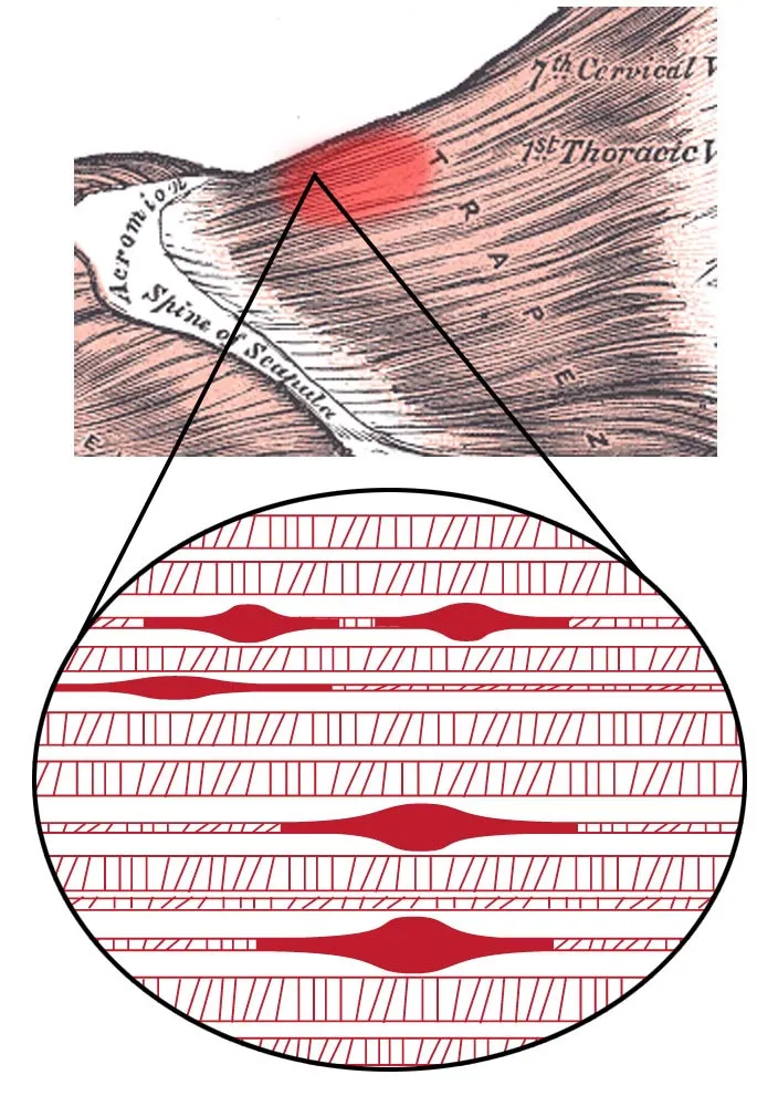 Schéma d’un trigger point dans la fibre musculaire